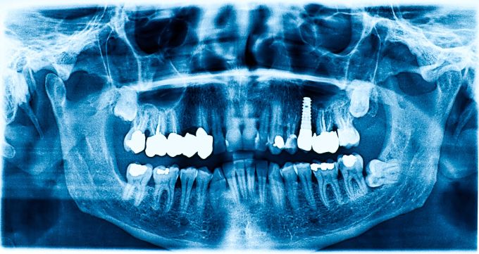 dental xray